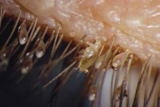 Eyelash Mites caused by bad lash extensions